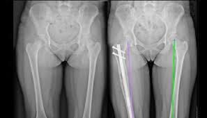 What You Need To Know Before Considering Limb Lengthening Surgery?